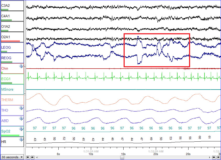 polysomnography